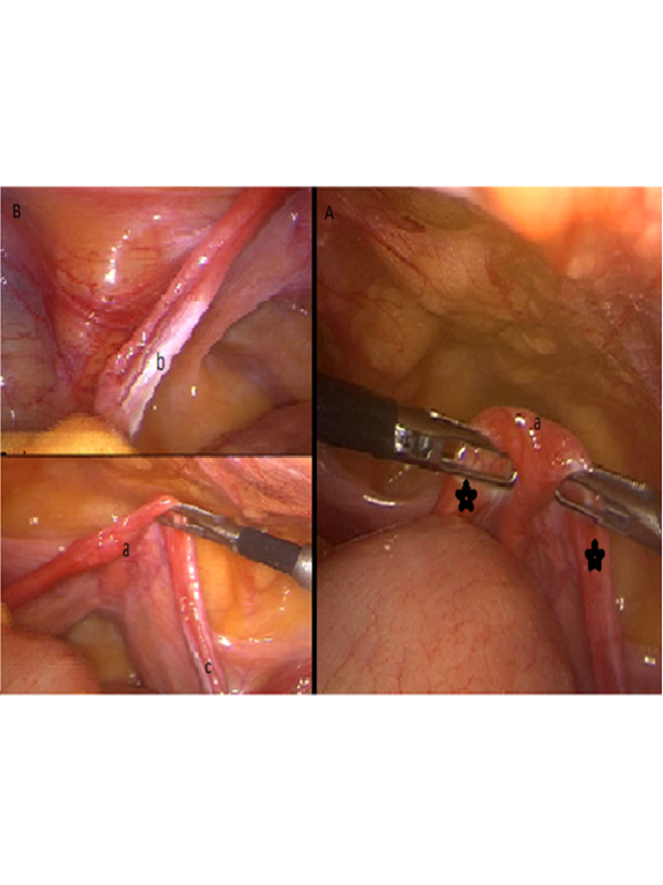 46, XY Disorder of Sex Development