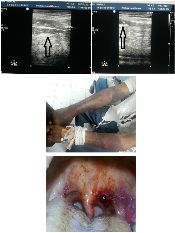 Heparin Induced Thrombocytopenia Due to Low Molecular Weight Heparin