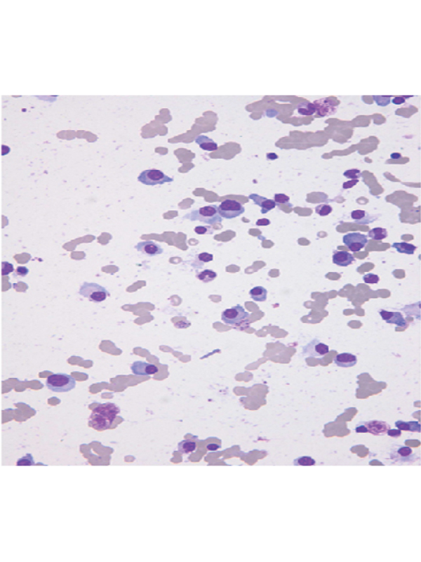 Concomitant Plasma Cell Tumor and Plasmodium Vivax Infection - Bone Marrow Aspiration