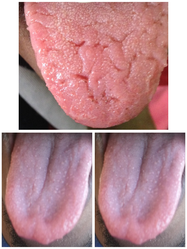 Tongue Abnormalities