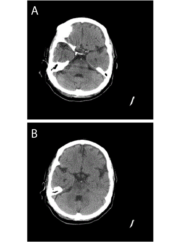 Hyperdense Basilar Artery Sign: An Indicator of Basilar Artery Thrombosis