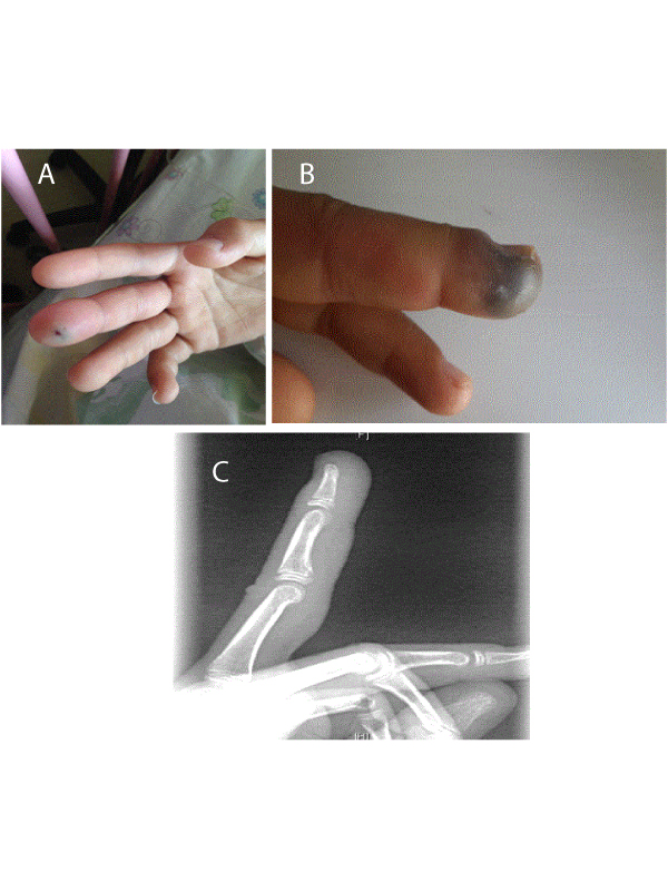 Pay Attention while Taking Fingertip Blood Sample in Neutropenic Patients