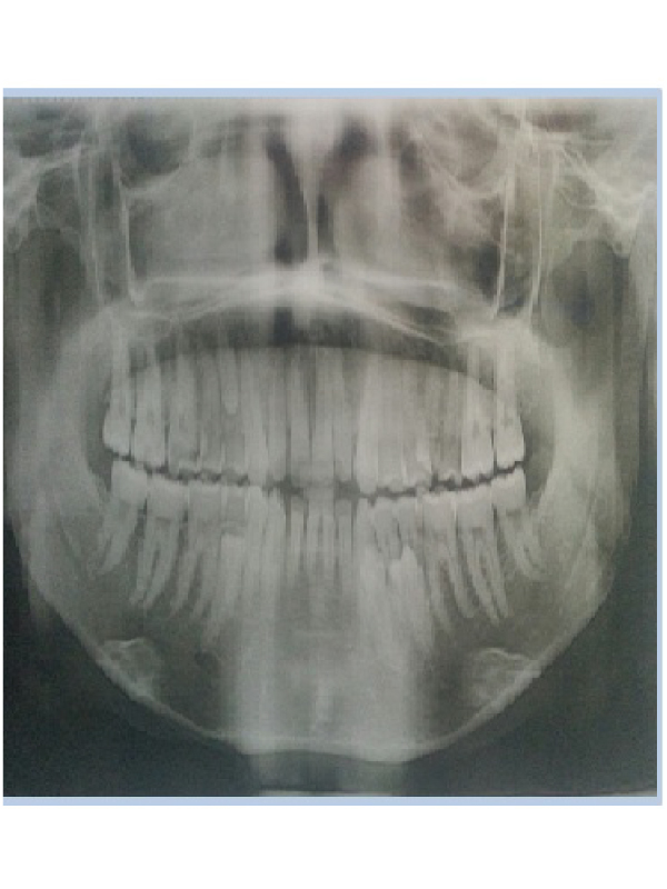 Multiple Supernumerary Teeth