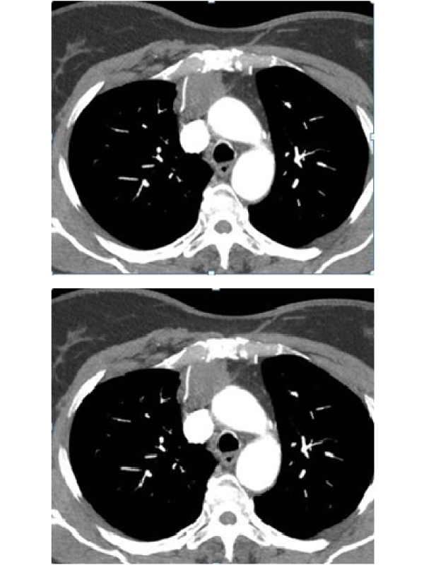 An Uncommon Cause of Dyspnea