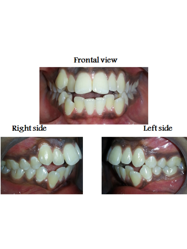 Anterior Open Bite With Sever Crowding Upper and Lower Anterior Segments