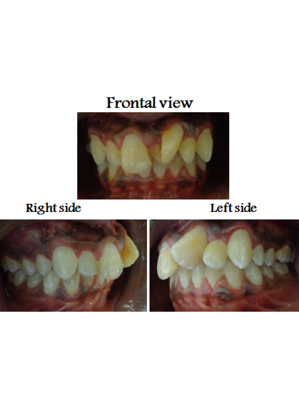 Supernummary Tooth between Upper Central Incisors with 90 Degree Rotation Upper Left Incisors