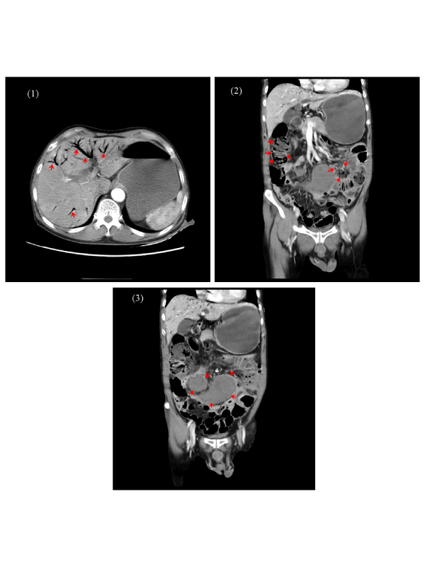 Traumatic Pneumatosis Intestinalis