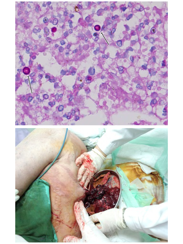 Fatal Primary Cutaneous Cryptococcosis