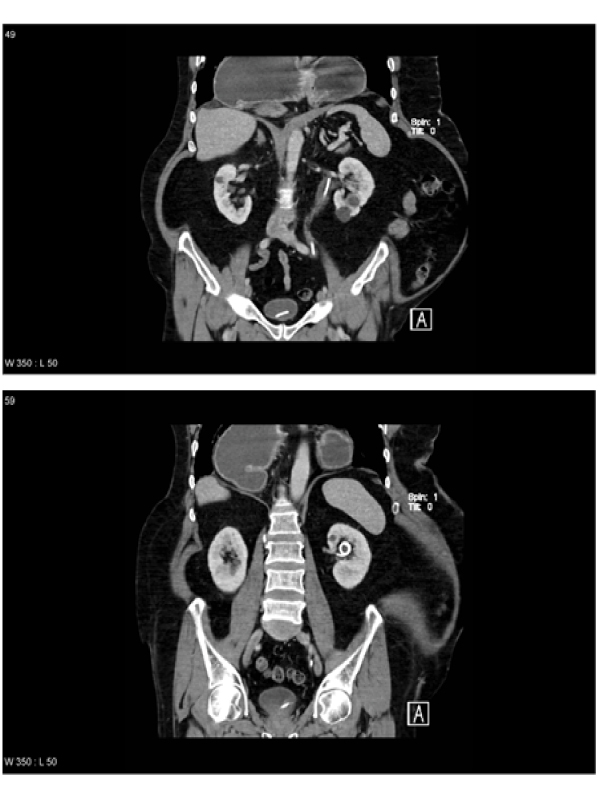 Hiatal Hernia