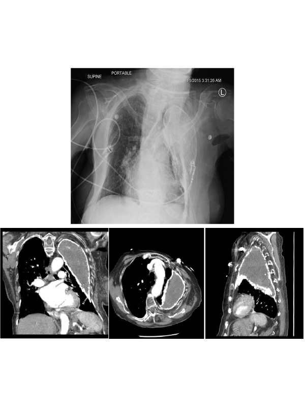 Fibrothorax as a Sequlae of Induced Pneumothoraces