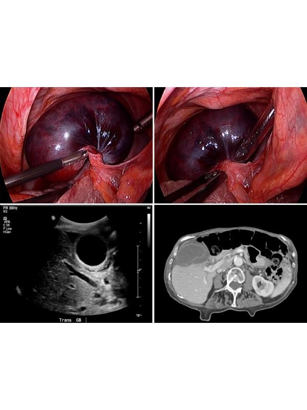 Gallbladder Volvulus: A Rare Emergent Cause of Acute Cholecystitis, if Untreated, Progresses to Necrosis and Perforation