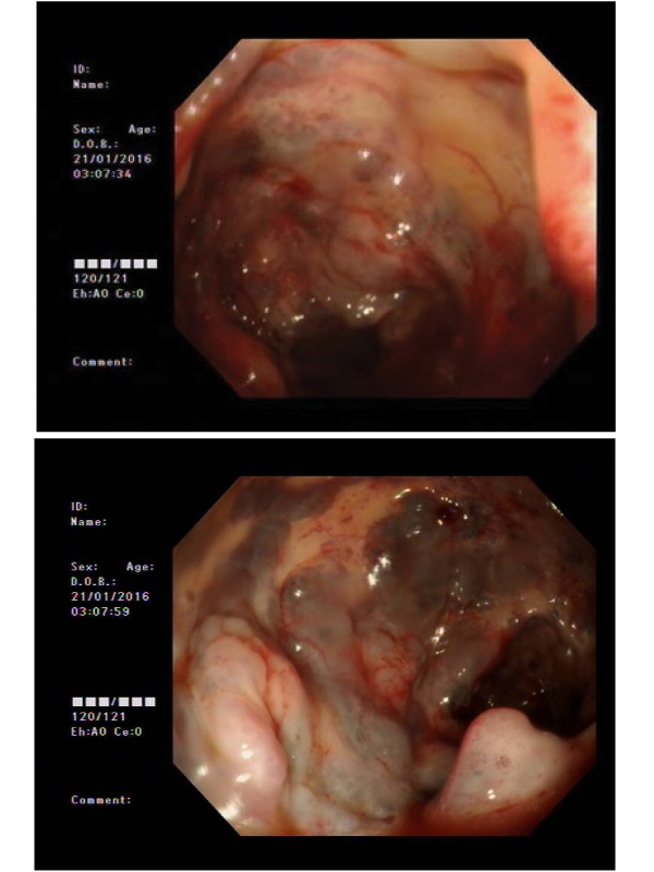 A Rare Presentation of Dilated Colonic Varices