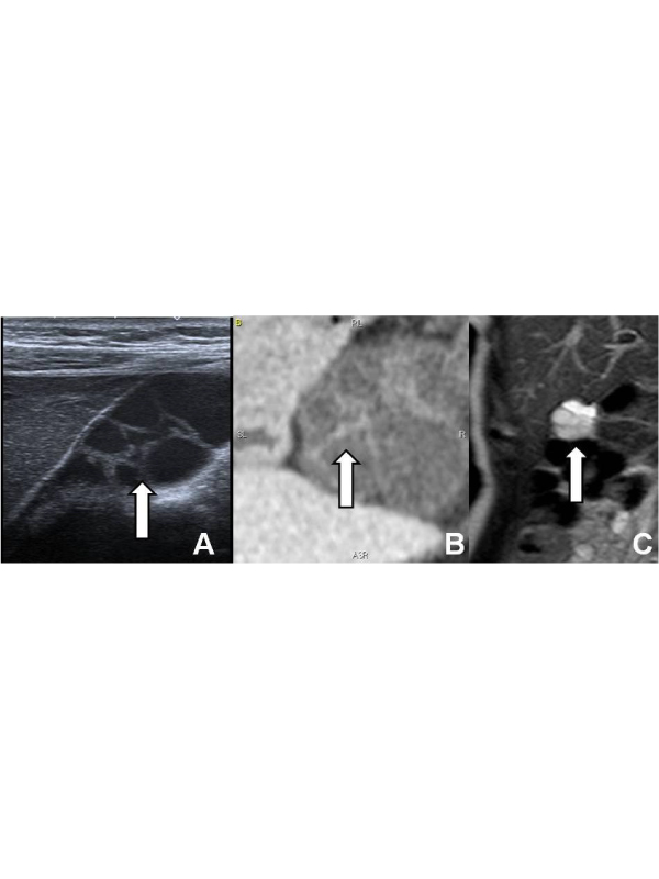 An Unusual Right Upper Quadrant Pain Cause: Multiseptate Gallbladder