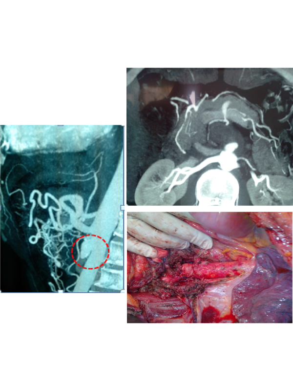 A Superior Mesenteric Artery Mycotic Aneurysm Caused by Streptococcus equi Treated Surgically