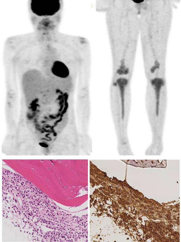 Symmetrical Bone Lesion in Both Knees of Patient with Multiple Myeloma