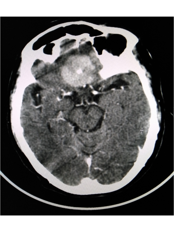 Planum Spheroidale Meningioma