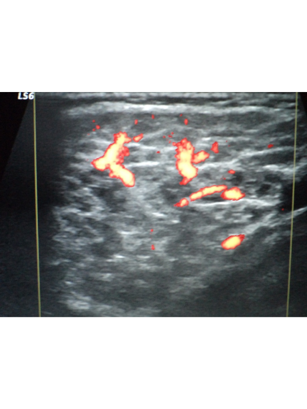 Sonographic Picture of Sjï¿½grenï¿½s Syndrome