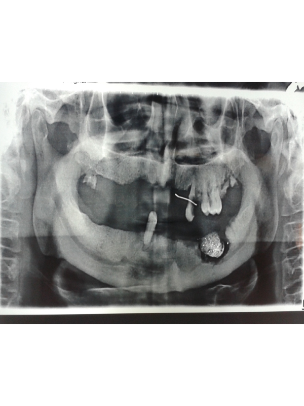 Zoledronic Acid Induced Osteonecrosis of the Jaw