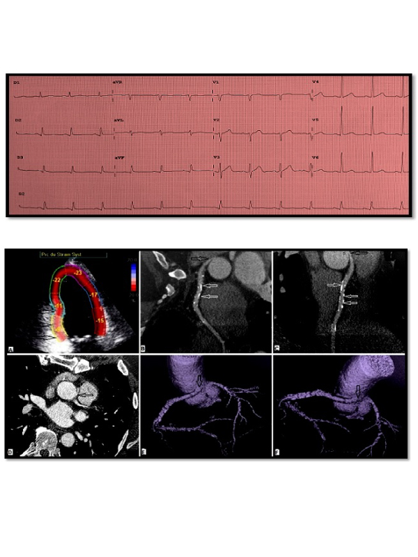 Anomalous Origin of the Right Coronary Artery with Inter-Aorto-Pulmonary Course Highlighted by ECG-gated Cardiac CT Angiography