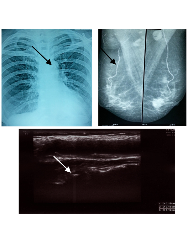 Mammary Artery Calcification a Useful Marker for Coronary Artery Disease