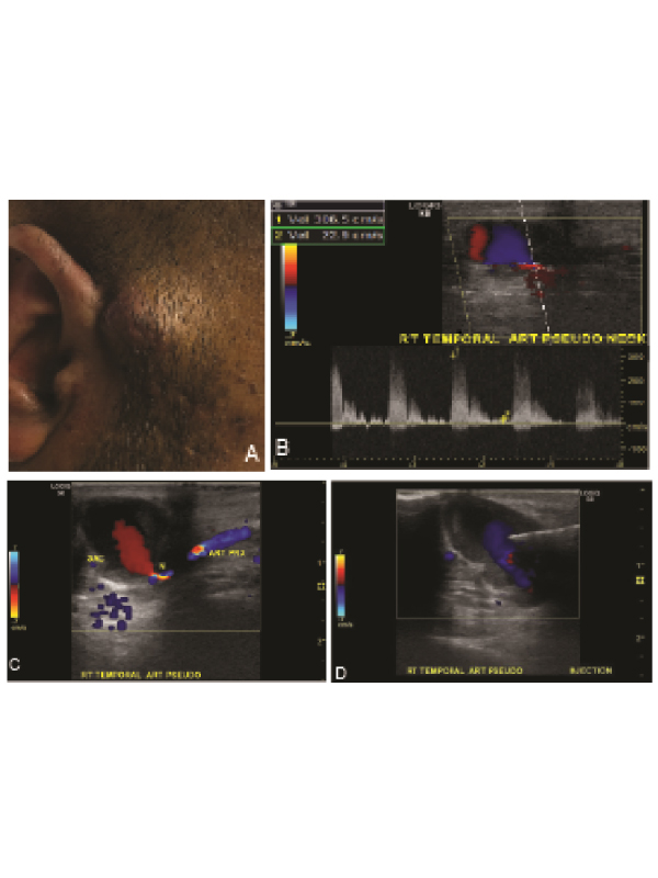 Ultrasound-Guided Temporal Artery Pseudoaneurysm Repair with Thrombin Injection