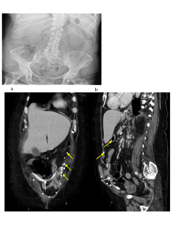 Abdominal Trompe-Loeil Spirals