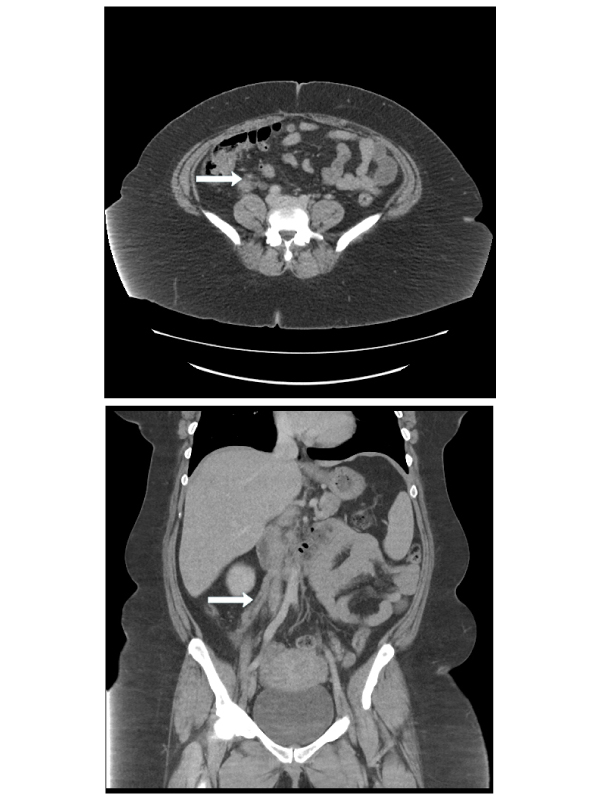 Idiopathic Ovarian Vein Thrombosis in a Healthy Individual