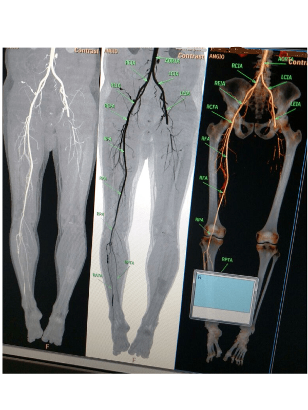 Extensive Peripheral Arterial Disease