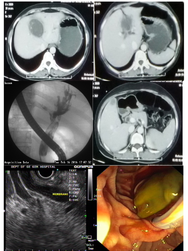 Myriad Imaging Appearances of Biliary Hydatidosis