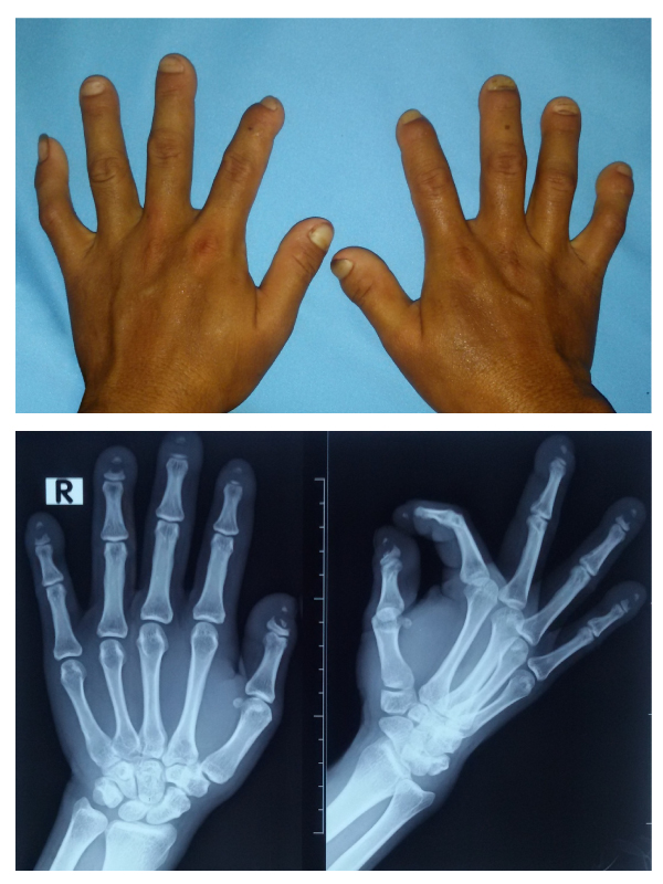 Band-like Acral Osteolysis in Limited Cutaneous Scleroderma