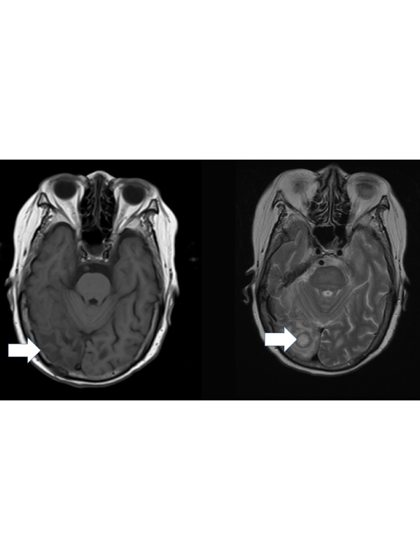 Nocardia Brain Abscess in a Patient of Lung Cancer