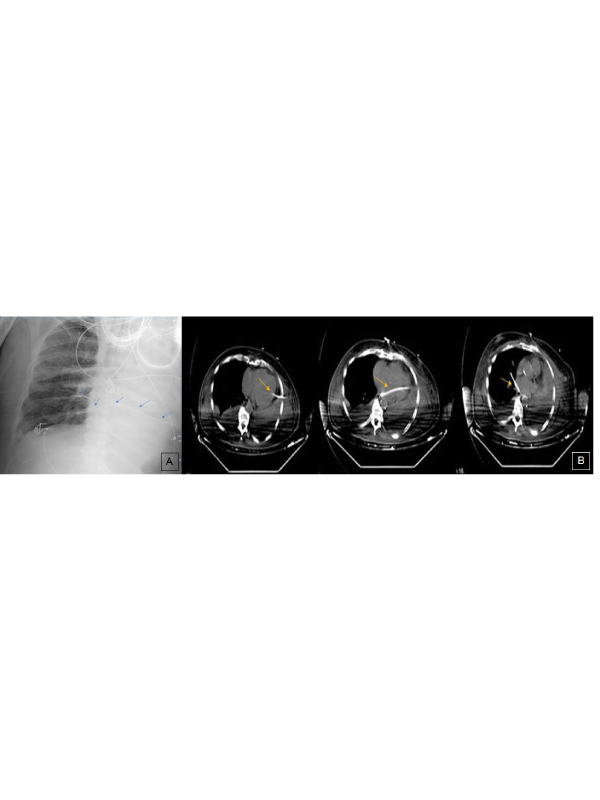 A Pleural Catheter Malposition through Mediastinum to Contralateral Hemithorax: An Interesting Image