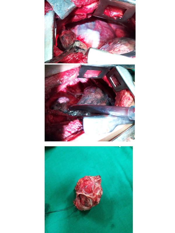 Mediastinal Mass Excision-Simple and Safe in Non-specialised Centres