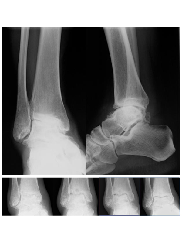 Ankle Joint Damage Treated with Infliximab in a Patient with Rheumatoid Arthritis