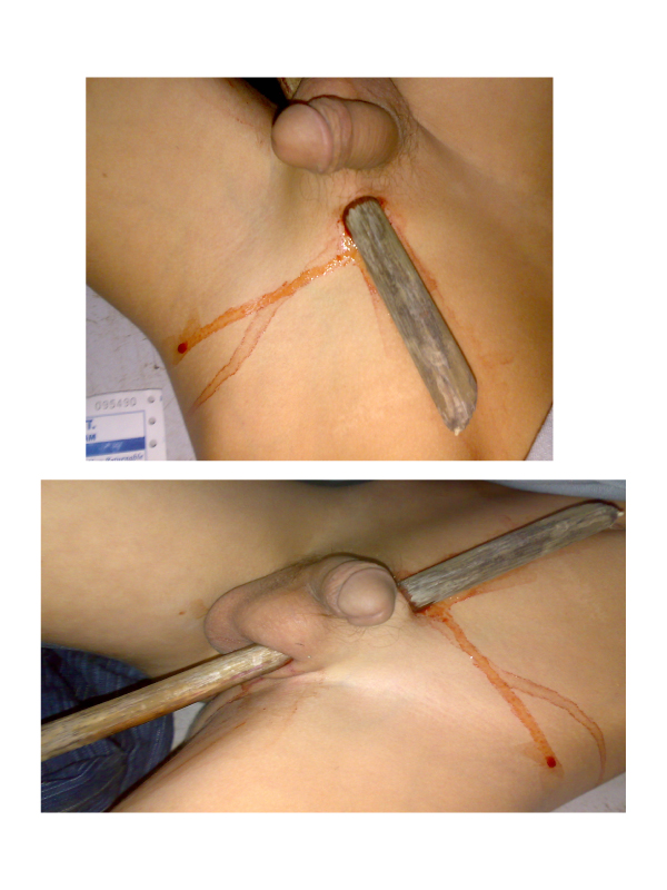 Unusual Case of Penetrating Scrotal Injury in a Child