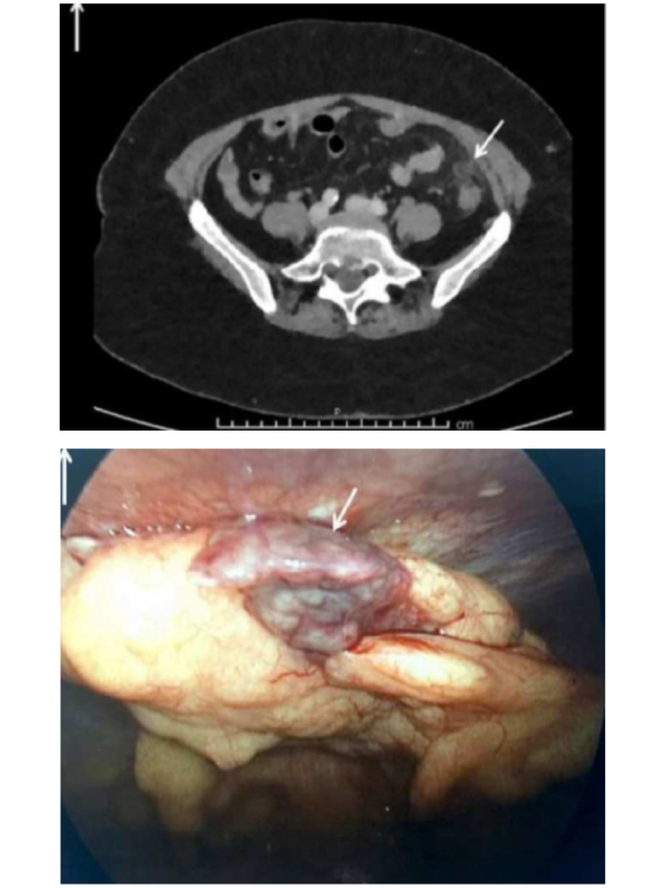 Treatment of Epiploic Appendigitis Using Laparoscopic Electrocautery Technique