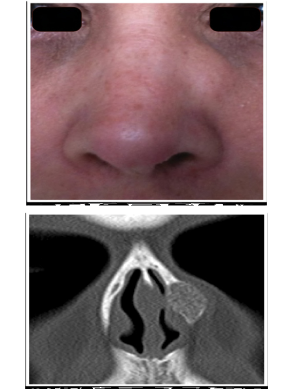 Nasal Intraosseous Hemangioma: A Honeycomb Lesion