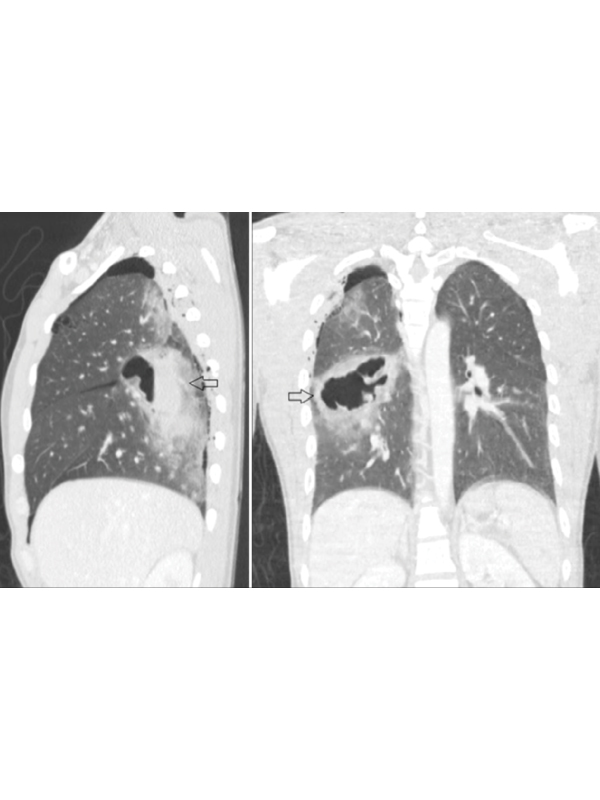 Chest CT Results in Diagnosis of Post-traumatic Haemato Pneumatocele