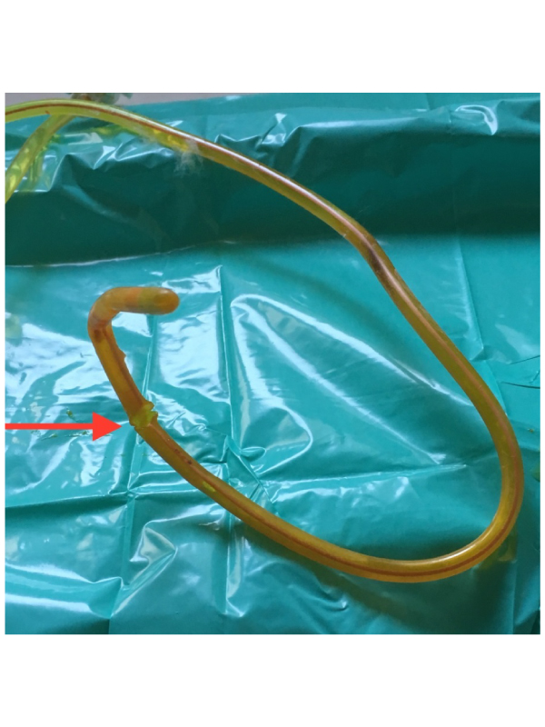 Spontaneous Rupture of Long-Indwelling Nasogastric Tube: An Unforeseen Complication