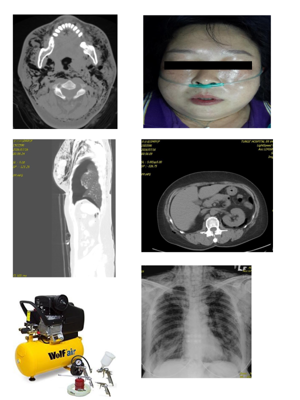 Severe Traumatic Pneumothorax, Pneumomediastinum and Pneumoperitonium