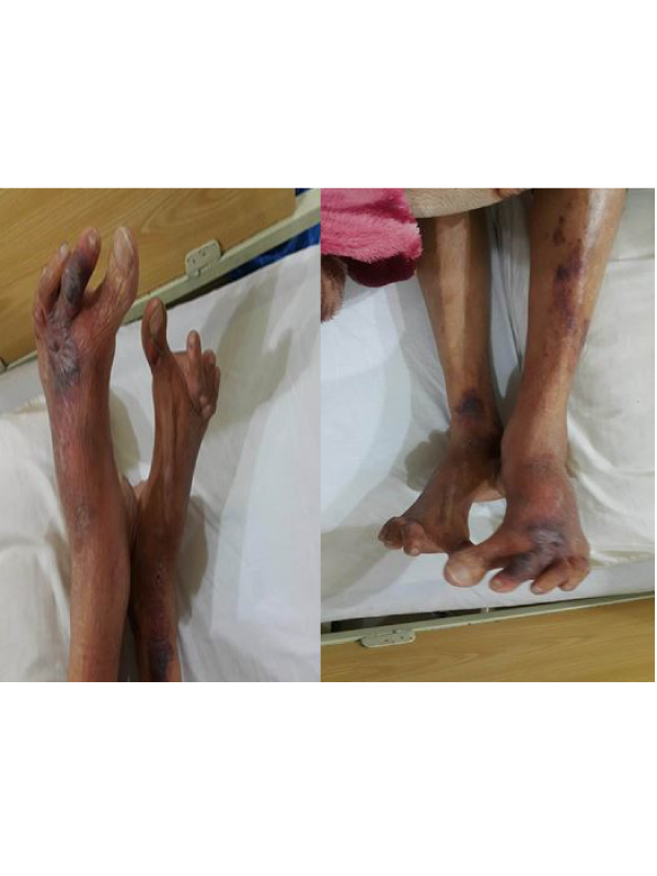 A Common Circulatory Condition: Peripheral Arterial Disease