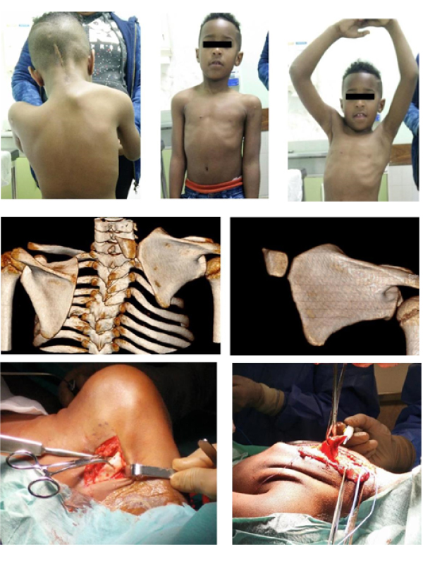 Sprengel Deformity and Omovertebral Bone