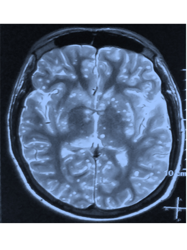 Starry Sky: Neurocysticercosis, an Old Disease