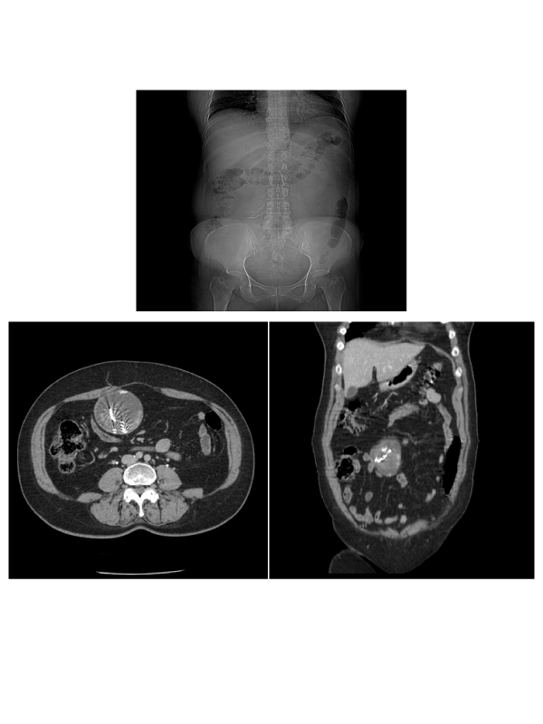 Abdominal Gossypiboma: A Diagnostic Dilemma in Late Postoperative Period