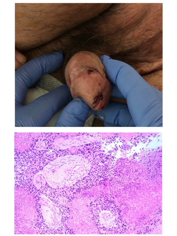 A Rare Cavernous Metastasis of a Bladder Tumor