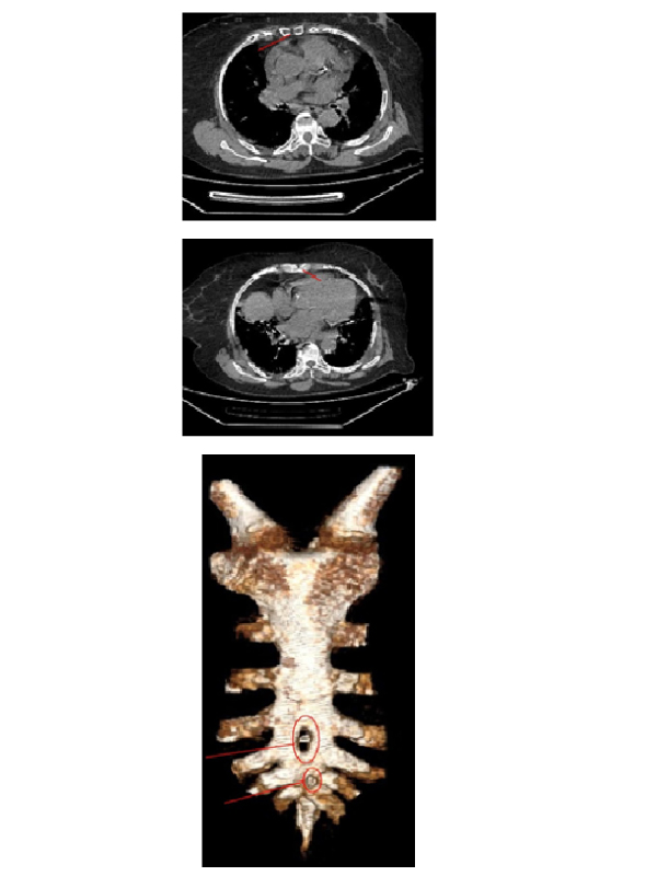 An Anatomic Abnormality: Double Sternal Foramina