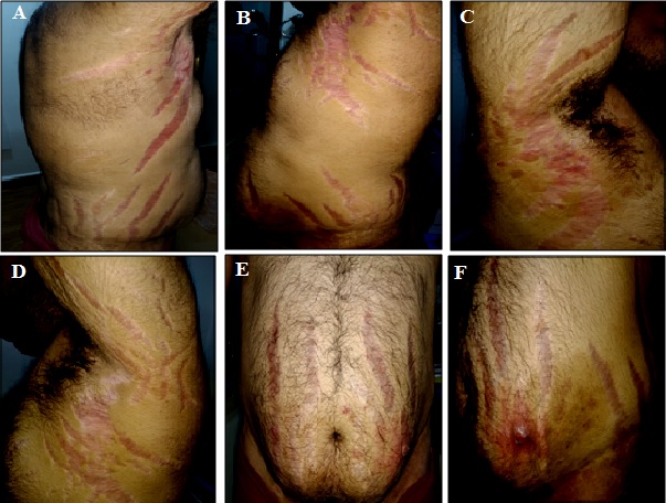 Hypercortisolism Signature: A Florid Case of Iatrogenic Cushing's Syndrome Induced by Topical Steroid