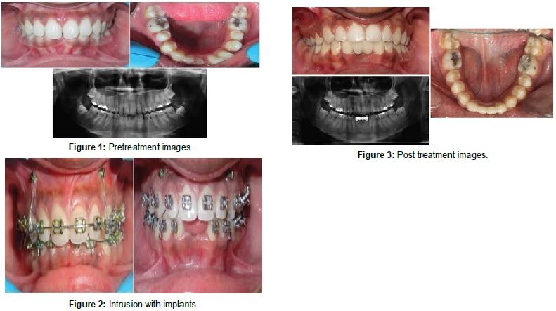 Preprosthetic Orthodontic Treatment of Deep Bite with Congenitally Missing Mandibular Central Incisors