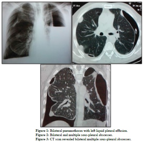 Multiple Pulmonary Sous-Pleural Tuberculous Abscess Treated Surgically