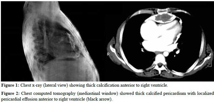 A Calcified Heart